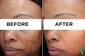 Acne scars can be treated with laser resurfacing, a procedure which removes the top layer of skin. Here Are Some Life Changing Products For Acne Scars And Dark Spots