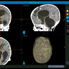 1. Preoperative Planning. Frameless Magnetic Neuronavigation.