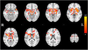 The campalgn study of parkinson's disease: Network Structure Of Brain Atrophy In De Novo Parkinson S Disease Elife