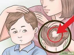 Tinea capitis or ringworm of the scalp is the most common cause of hair loss in children. How To Stop Hair Loss In Children With Pictures Wikihow