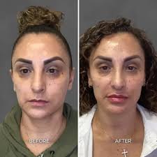 Albuquerque Full Face Balancing Before & After: Chrome Aesthetics