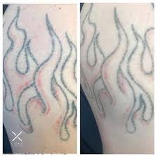 Classy tattoo company here for all your tattoo, body piercing and laser tattoo removal needs! This Is A Before And After Of A Clients First Session Completely Healed You Can Already See A Bit Of A Difference Tattoos Tattoo Removal Laser Tattoo Removal