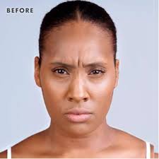 Xeomin Wrinkle Treatments