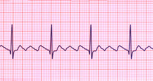 Image result for Atrial Fibrillation