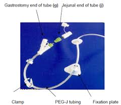 Newcastle Hospitals Percutaneous Endoscopic Gastro Jejunostomy Peg J Children Pre Operative Information