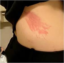 Image result for Dermatographism