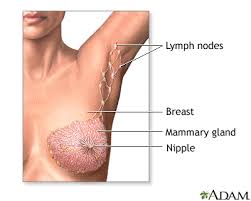 Thickness or redness of the skin, along with a little puffiness like the skin of an orange is a. Breast Cancer Information Mount Sinai New York