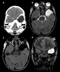 Image result for Incidental Imaging Finding