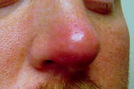 Symptoms, causes, treatment, home remedies, removal, pictures and waxing information. The Rudolph Sign Of Nasal Vestibular Furunculosis Questions Raised By This Common But Under Recognized Nasal Mucocutaneous Disorder