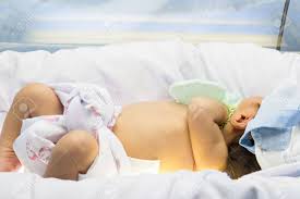 Although most cases are not caused by an underlying. Neonatal Jaundice Newborn Was Treated By Phototherapy Blue Light Neon At Upper And Lower Side Of Newborn Stock Photo Picture And Royalty Free Image Image 52765703