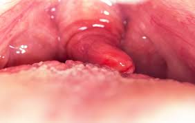 Image result for Uvulitis