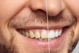 Image result for Teeth Whitening