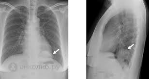 Betændelsesproces bestående af afrundet hos af histocytære celler (epitelioide makrodager) med en ring af lymfocytter udenom. Hamartom Art Diagnose Und Behandlung Je Nach Lokalisation Was Ist Ein Brusthamartom Und Wie Wird Es Behandelt