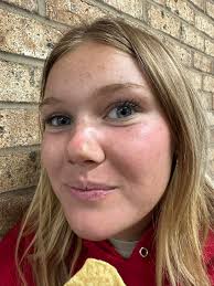 Her face is burned from the beach…