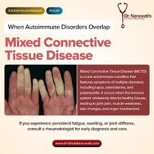 Image result for Connective Tissue Disorder