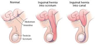 Inguinal hernias occur when soft tissue, usually intestines, protrudes from the abdominal cavity. Pediatric Inguinal Hernia Causes Symptoms Diagnosis Treatment