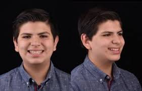 Orthopedic and orthodontic interceptive treatment of a class III  malocclusion. A case report.