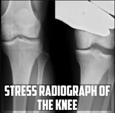 Image result for Knee XRay