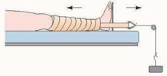 The nurse never releases the weights of traction unless specifically ordered by the physician. Pediatric Orthopedic Problems Nurse Key