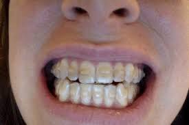 Maybe you would like to learn more about one of these? Anyone Else Drink Coffee And Develop Yellowing Of Invisalign Attachments What Do You Do Invisalign