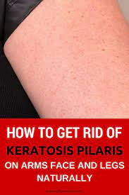 How To Get Rid Of Keratosis Pilaris On Arms Face And Legs Naturally Skin Bumps Keratosis Pilaris Chicken Skin