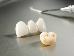 Drscottmaclean.com shows the new fcz (full contour zirconia) crowns on dental implants. National Dentex Dental Zirconia Crowns
