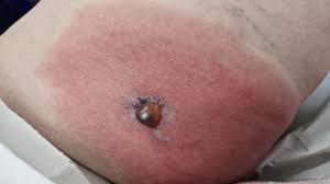 Image result for große winkelspinne biss haut reaktion