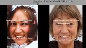 Difficult class III Lower complete metal based denture supported by dental  implants and upper complete metal based denture