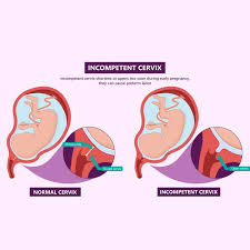 Image result for Friable Cervix