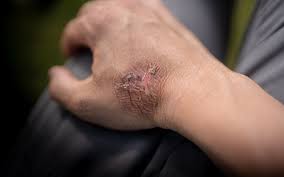 Burn Marks: How Can You Prevent & Treat Them? – Skinkraft