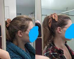 Rosemary oil may help promote hair growth. 24 Days Progress Rosemary And Peppermint Oil And Microneedling No Drugs Haircarescience