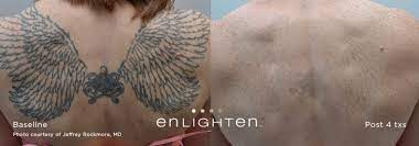 Other clinics may promise more aggressive tattoo removal treatments. Laser Tattoo Removal Anu Medical Spa Voorhees Nj
