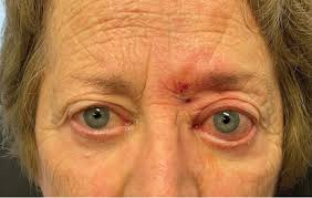 Image result for Proptosis