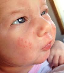 Baby eczema emollient balms and creams. Eczema Or Infant Acne How To Tell The Difference