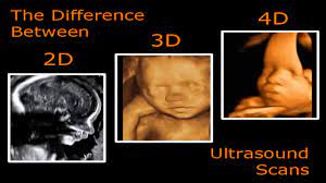 4d Ultrasound League City Tx Difference Between 2d 3d And 4d Ultrasound Youtube