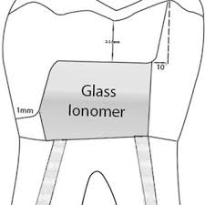 Pdf Considerations For Altering Preparation Designs Of Porcelain Inlay Onlay Restorations For Nonvital Teeth