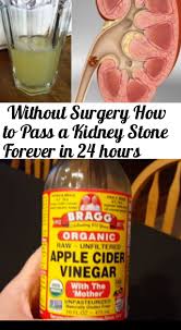 Without Surgery How To Pass A Kidney Stone Forever In 24 Hours Diet Kidney Stones Passing Kidney Stones Kidney