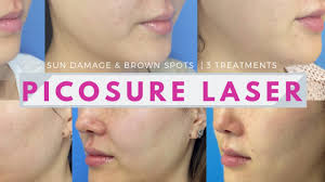 Saving you hundreds of pounds. Picosure Laser Review Before After Photos Organic Beauty Lover
