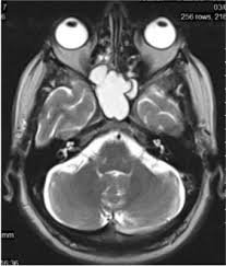 Ventral aspect of sphenoid bone. Endoscopic Treatment Of Sphenoid Sinus Mucocele Case Report And Surgical Considerations