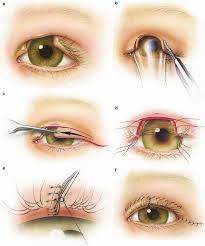 Image result for Eyelid Closure Defect