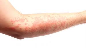 Ways To Manage Your Eczema Down To Earth Eczema Remedies Eczema Cure Homeopathy