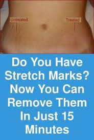 Olive Oil Bad For You What You Kneed To Learn About Olive Oil And The Preventative Measuresve In Refri Stretch Marks Aloe Vera For Skin Stretch Mark Remedies