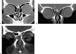 At first an access to the. Imaging Of The Paranasal Sinuses Ento Key