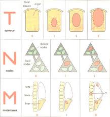 tnm classification and cancer staging simplified epomedicine