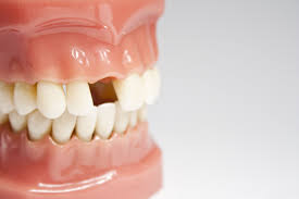 Missing Teeth And Hidden Risks What You Need To Know Best Dentist Teeth Dental