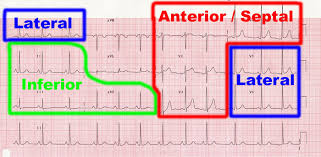Clinical Junior Com Ecg Ekg Interpretation Basics How To Read Mi Myocardial Infarction Angina Af Atrial Fibrillation St Elevation Depression