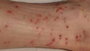 We did not find results for: World War Ii Bivouac Results In Misery Tick And Chigger Bites Linda Gartz