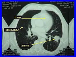 Actively scan device characteristics for identification. Limited Stage Small Cell Lung Carcinoma Wikipedia