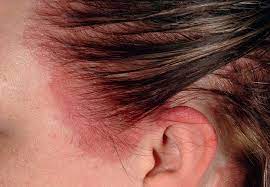 Welche prozesse laufen dabei ab? Allergische Reaktionen Vom Spattyp Fallstricke Bei Der Diagnose