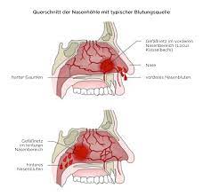 Epistaxis Nasenbluten Deximed